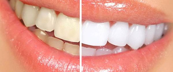 Diş rengi neden değişir?