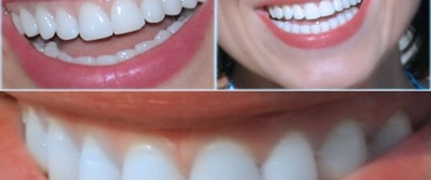 Hamilelikte diş çürükleri artar mı?