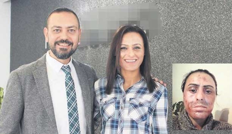 Estetik tedavisi öncesi ve sonrası Bolat'ın yüzü.