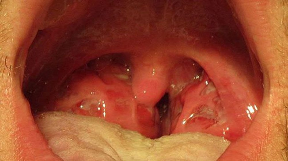 Strep A 9 çocuğu öldürdü: Küresel endişeye neden olan Strep A nedir, belirtileri neler ve Türkiye'de görüldü mü? - 10