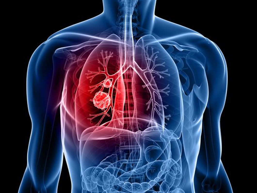 metastatik akciger kanserinde ameliyat