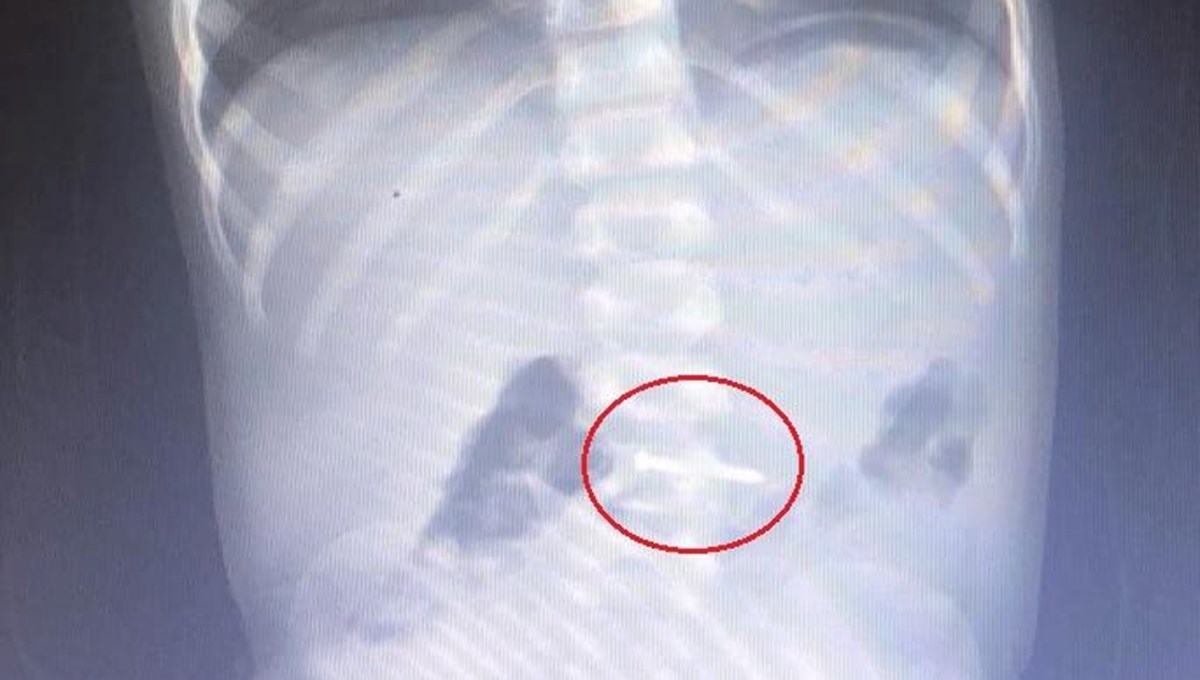 2 yaşındaki Asil yerde bulduğu çiviyi yuttu 2 yaşındaki Asil yerde bulduğu çiviyi yuttu