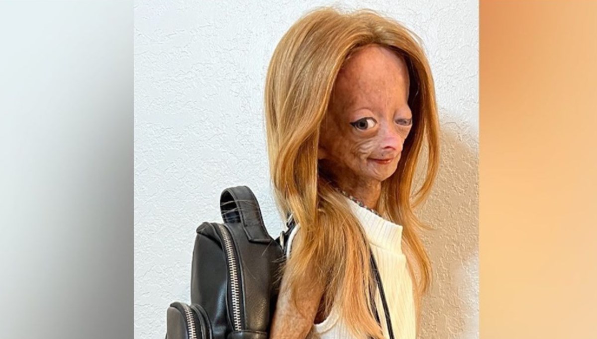 Benjamin Button hastalığıyla mücadele eden YouTuber Adalia Rose Williams hayatını kaybetti