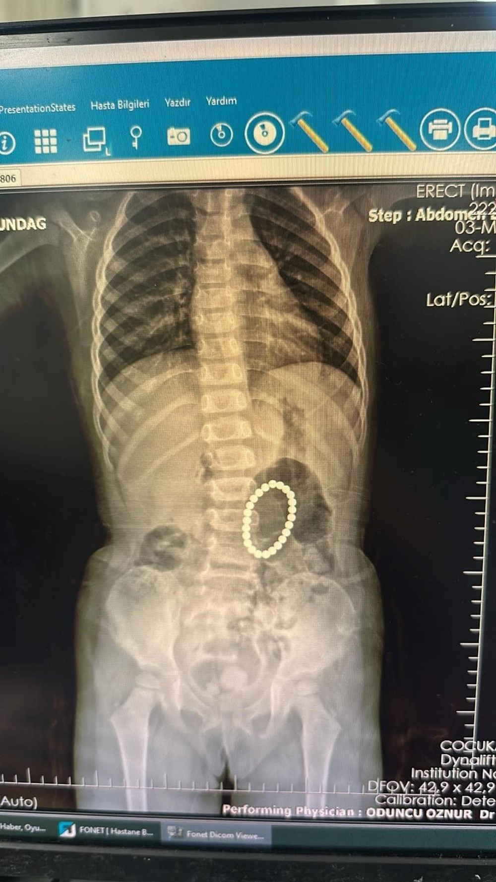 4 Yaşındaki Çocuğun Bağırsaklarında Bileklik Şoku: Doktorlar Gördüklerine İnanamadı! 73 OXTqbWUdUeMQKVFq3pFIQ