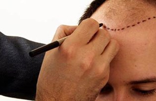 Sac Ekimi Hastane Ortaminda Yapilmali Istanbul Da Her Gun 5 Bin Sac Ekimi Yapiliyor Saglik Haberleri Ntv