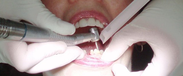 Diş çürüğü kanser riskini azaltıyor Sağlık Haberleri NTV