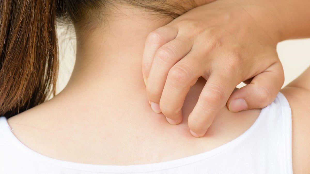 Alerji Kurdesen Olarak Da Bilinen Urtikerin Sebepleri Arasinda Degil Saglik Haberleri Ntv