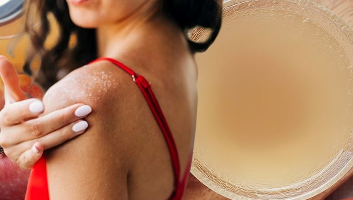 Güneş yanığı, kaşıntı ve iltihaba iyi geliyor! Doğal mikrop öldürücü, 20 dakika bekletmek yetiyor Güneş yanığı, kaşıntı ve iltihaba iyi geliyor! Doğal mikrop öldürücü, 20 dakika bekletmek yetiyor