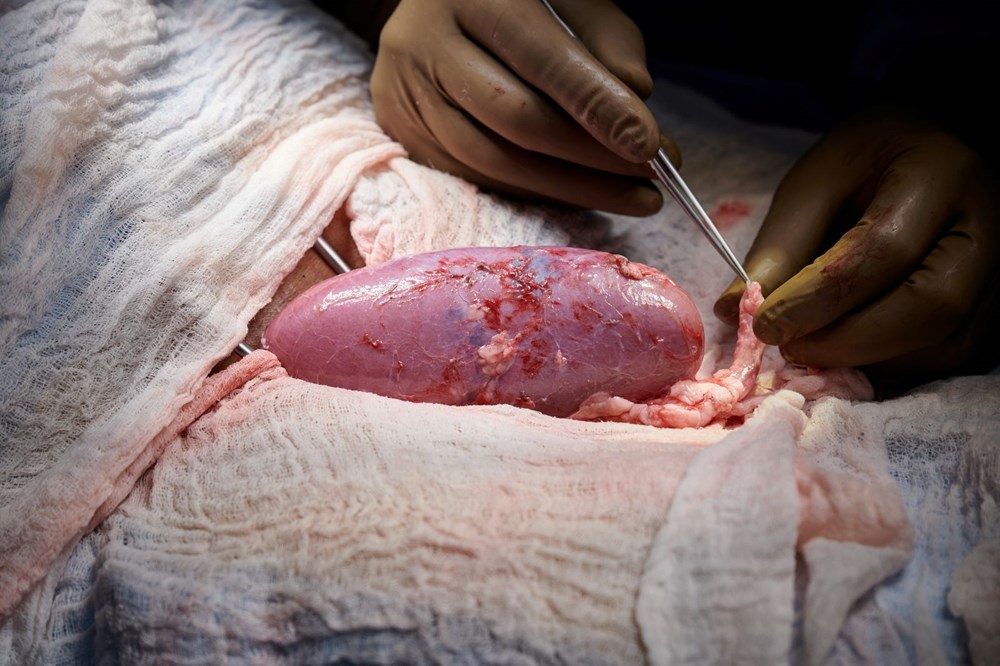 Dünyada ilk kez hayvandan alınan organ bir insana başarıyla nakledildi: Yüz binlerce hayatı kurtarabilir - 1