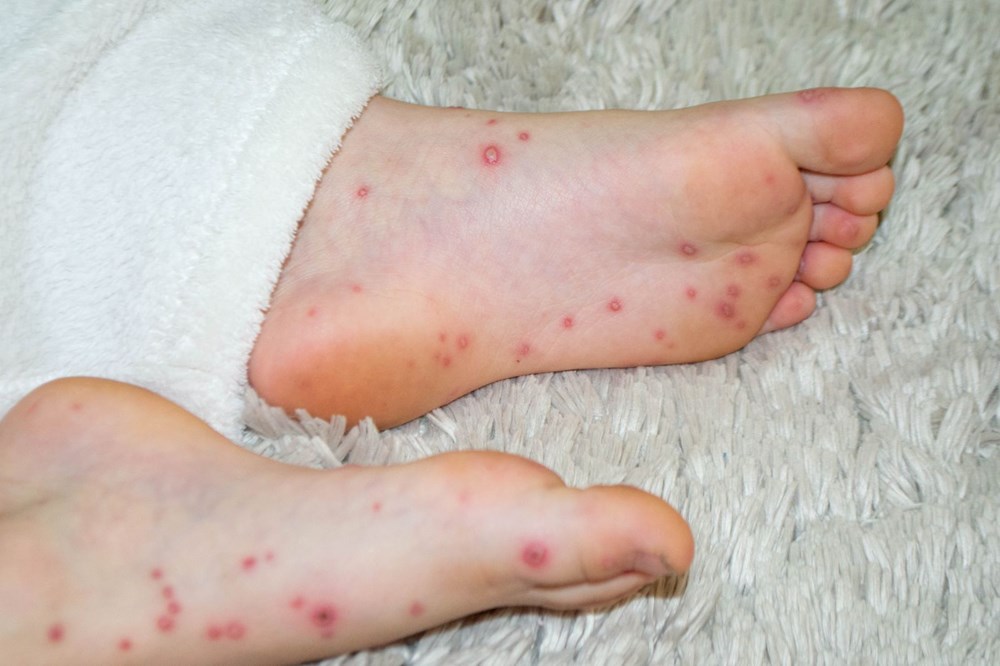 Yeni salgın alarmı: Domates gribi (Domates gribi belirtileri neler?, bulaşıcı mı? tedavisi var mı?) - 7