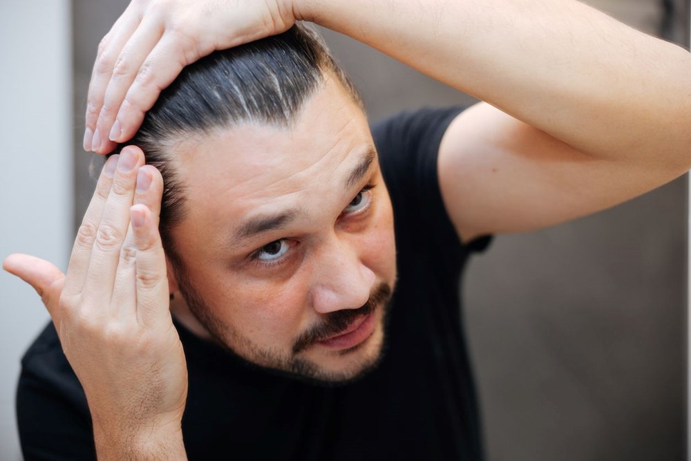 Erkeklerde saç dökülmesinin en değerli 5 nedeni: Kel kalabilirsiniz 74
