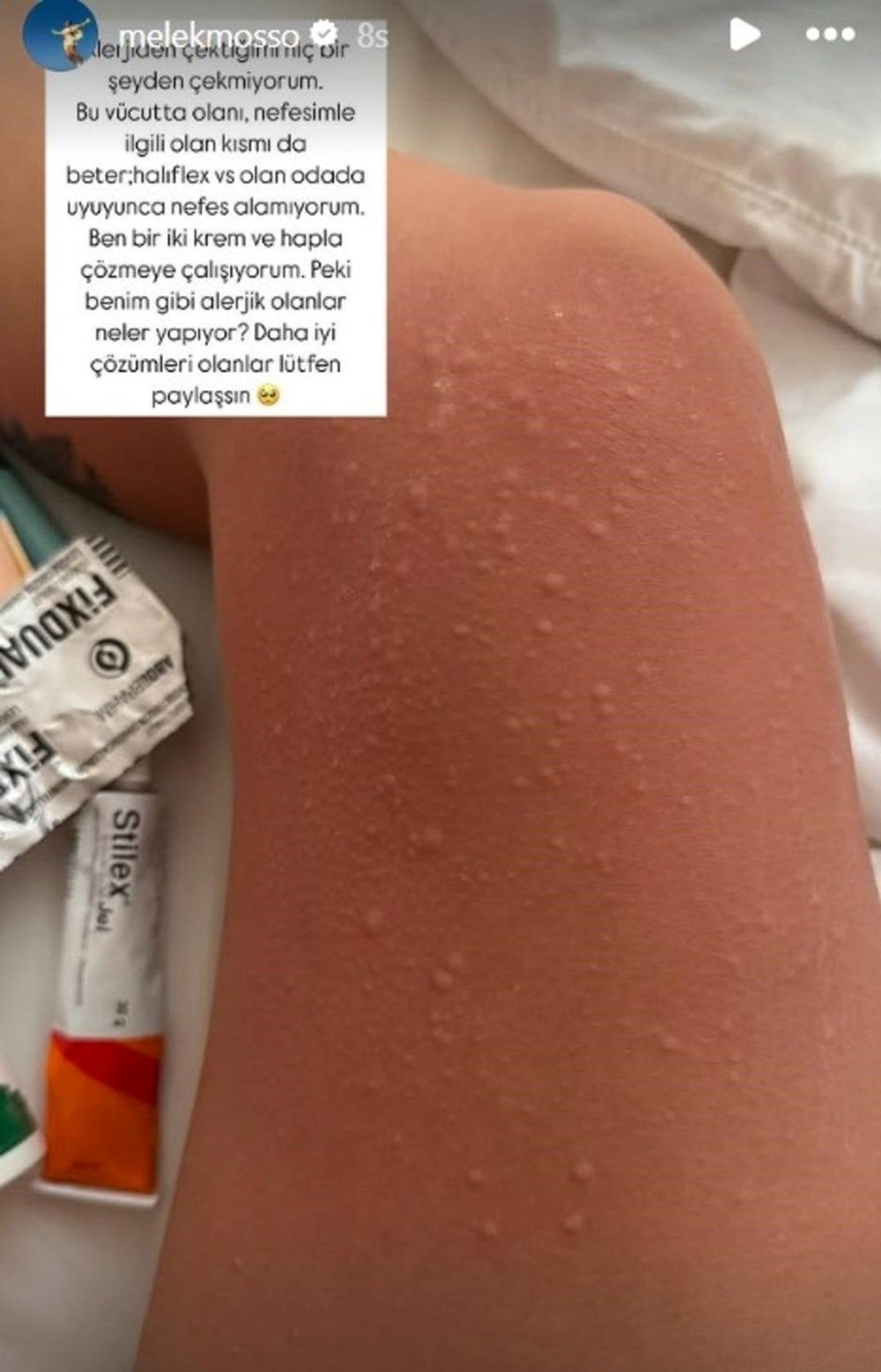 Melek Mosso: Bali Belly hastalığına yakalandım - 3