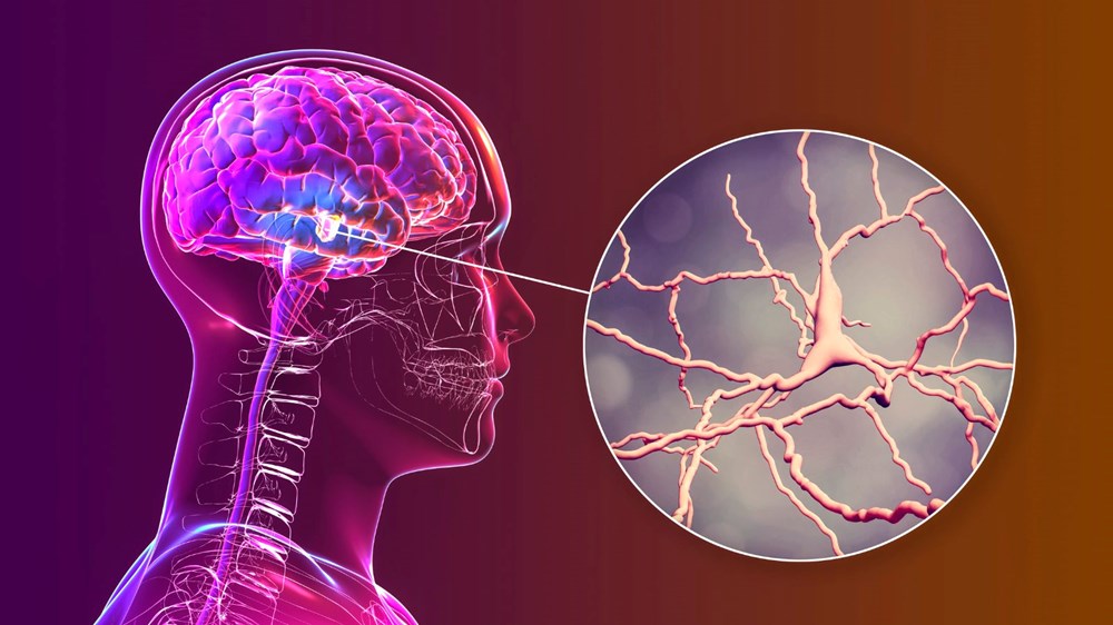 Parkinson teşhisi için sıra dışı yöntem - 2