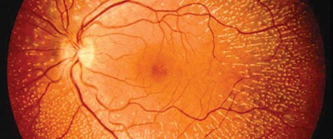 Macula lutea. Macula lutea. Фовеа. Макула и фовеа. Сетчатка глаза анатомия.