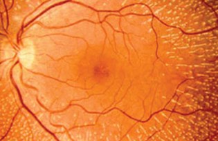 retina yirtigi kor edebilir saglik