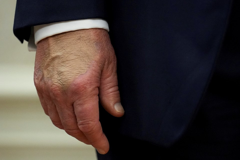 Trump'ın kalp yaşı 65 çıktı - 1