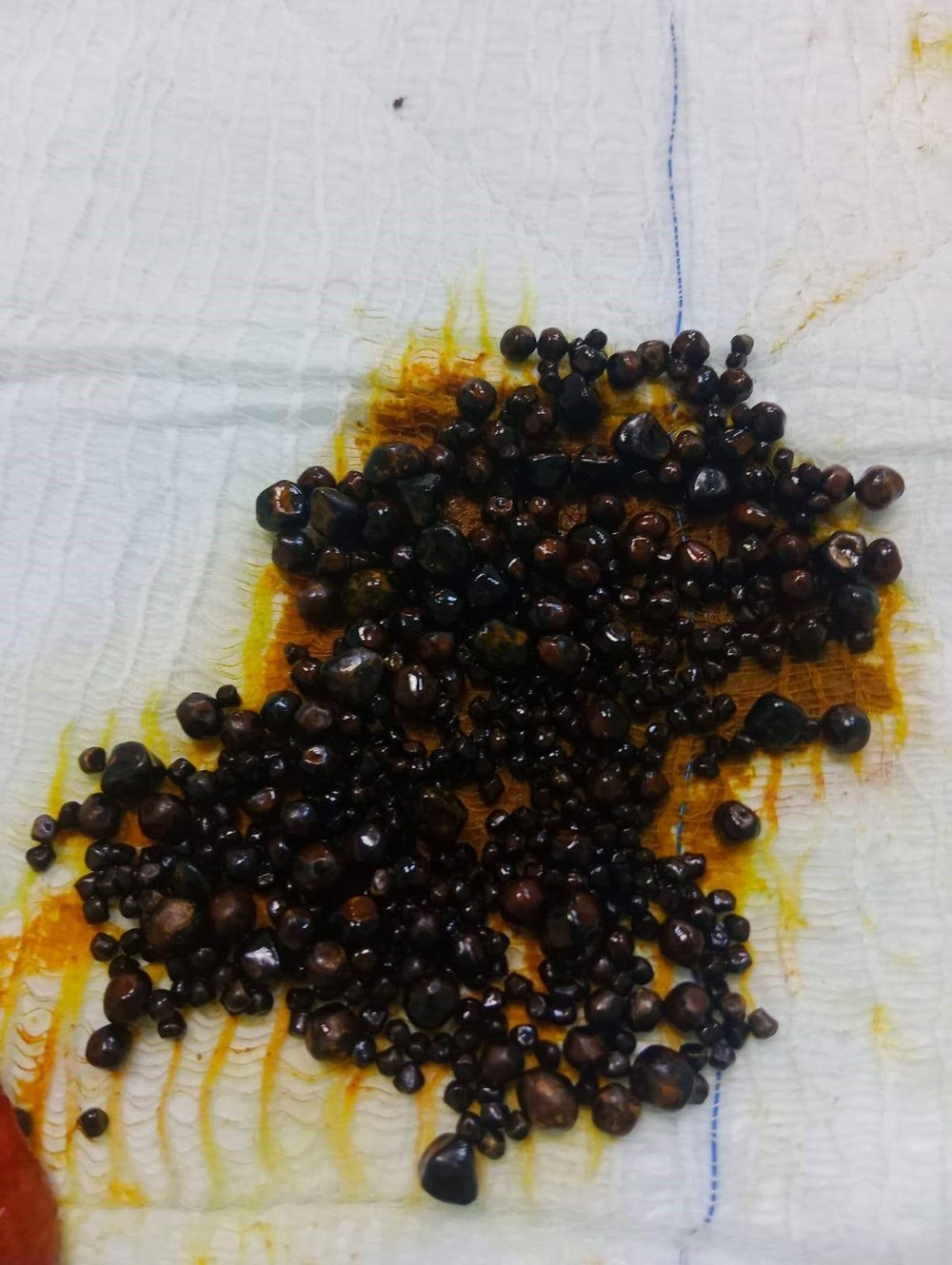 Doktorlar bile şaşırdı: Hepsi safra kesesinden çıkarıldı - 3