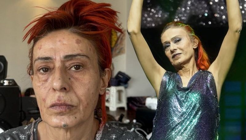 Yıldız Tilbe'nin yüzünde yanıklar oluşmuştu: Olayın perde arkasını anlattı