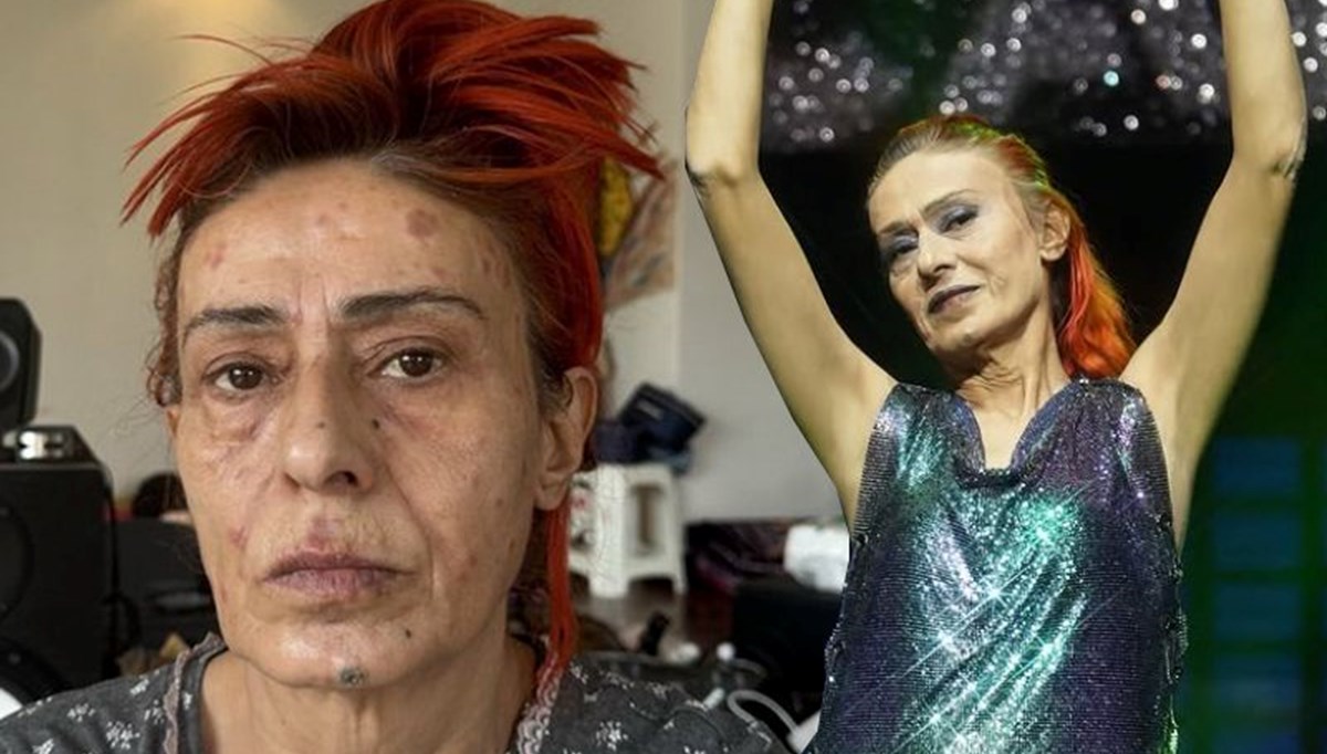 Yıldız Tilbe'nin yüzünde yanıklar oluşmuştu: Olayın perde arkasını anlattı