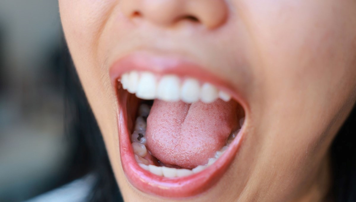 Ölümcül hastalığın erken belirtisi, dilde ortaya çıkıyor