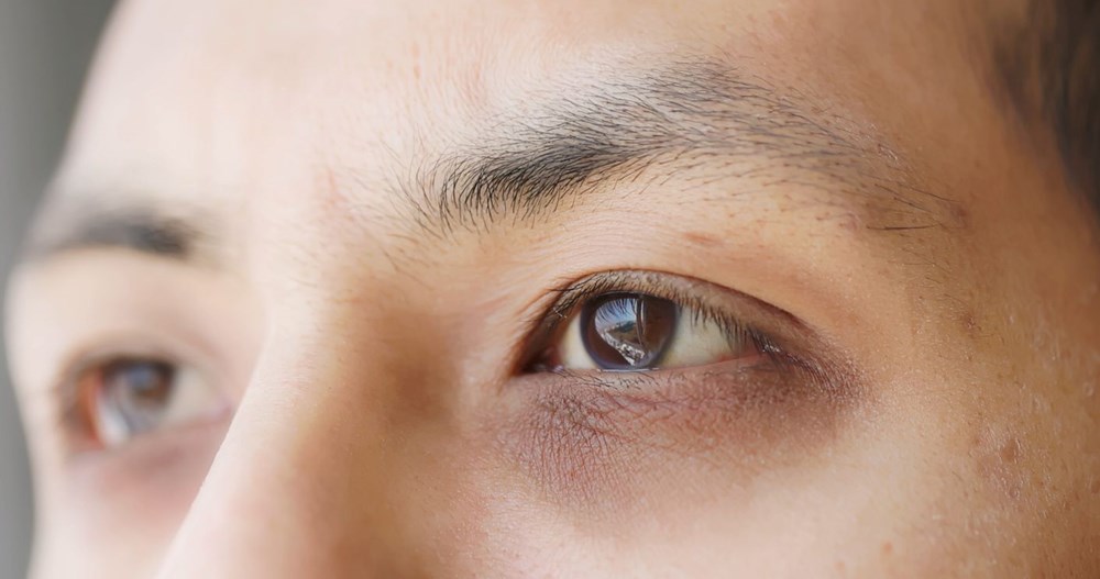 Göz altı morluklarının gizli riski: 5 ciddi hastalığın sinyali - 1