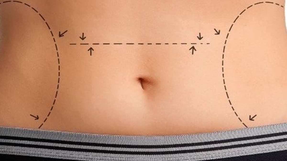 Mini Karin Germe Ameliyati Diyet Ve Egzersize Direncli Hastalara Umut Oluyor Saglik Haberleri Ntv