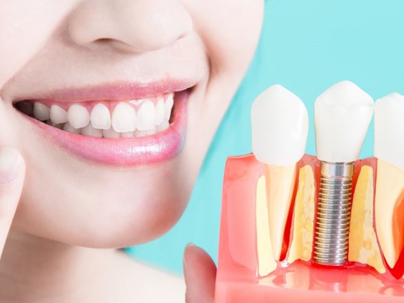 implant tedavisiyle ilgili 5 soru 5