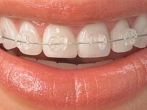 Ortodonti Icin Gec Degil Saglik Haberleri Ntv