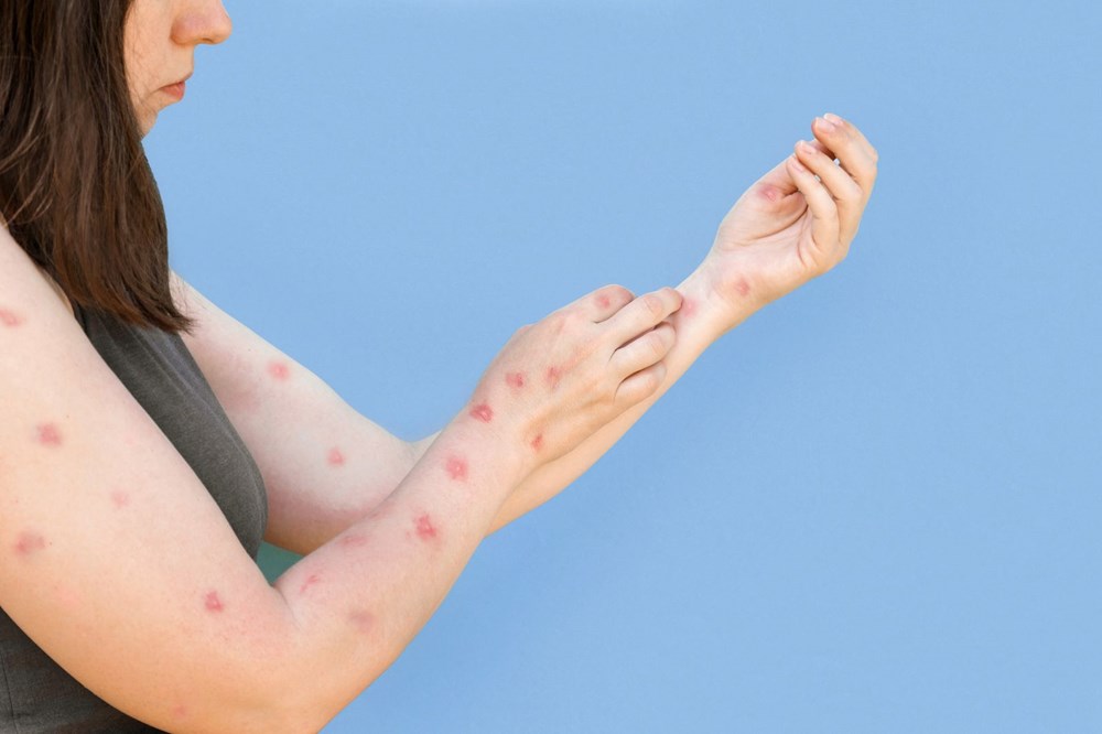 Sağlık Bakanlığı'ndan'maymun çiçeği' rehberi - 7