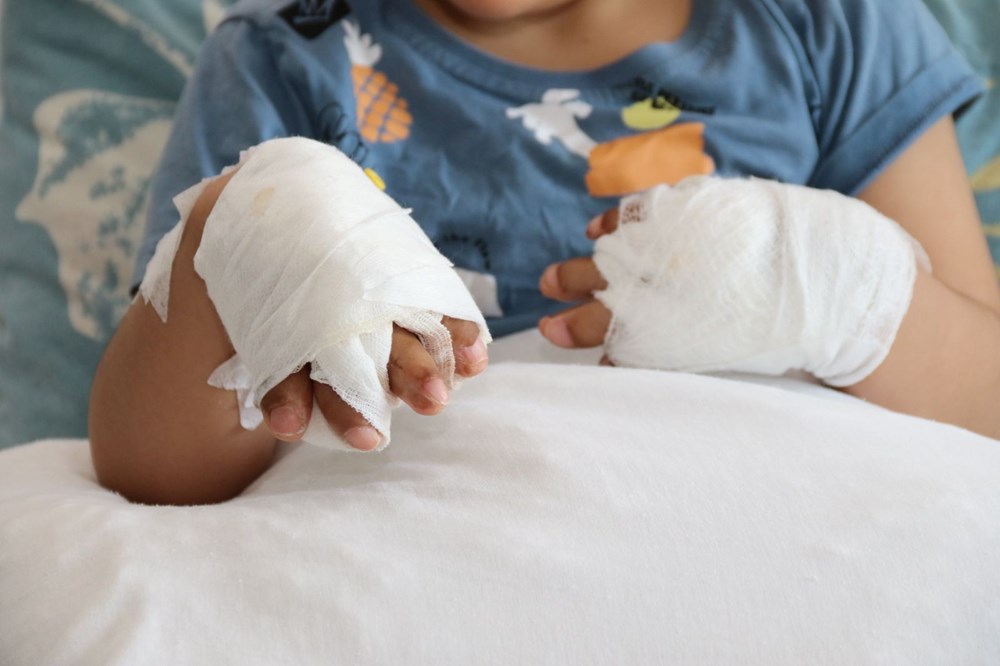 Doktorların bile ismini yeni duyduğu hastalık: 4 yaşındaki Umut'ın 10 parmağı açıldı - 2