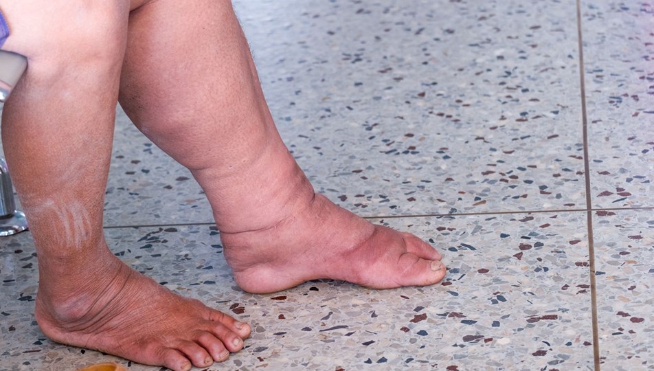 Fil ayağı hastalığı nedir, belirtiler nelerdir? Fil ayağı hastalığı neden olur?