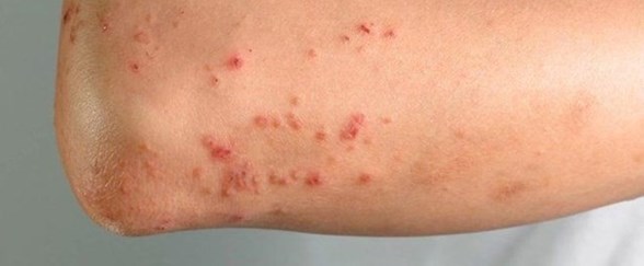 sarbon hastaligi nedir belirtileri nelerdir sarbon nasil bulasir saglik haberleri ntv sarbon hastaligi nedir belirtileri nelerdir sarbon nasil bulasir saglik haberleri ntv