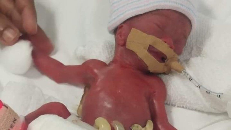 Dünyanın en küçük bebeği 13 aylık tedavinin ardından taburcu oldu - 1