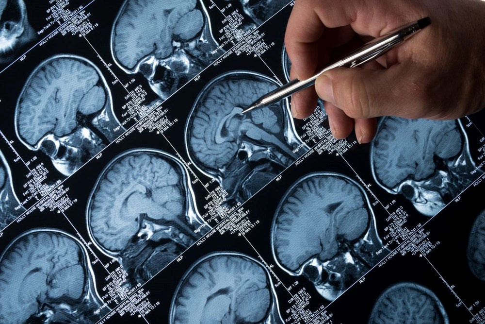 Alzheimer için umut veren keşif: İlk belirtiler gözlerde ortaya çıkıyor - 5