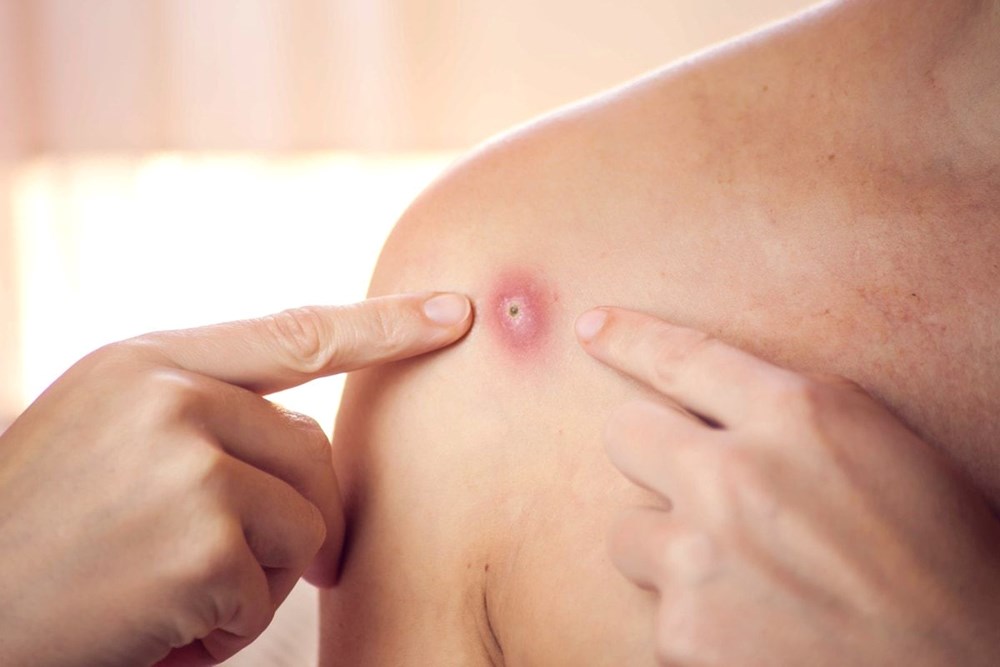 Maymun çiçeği virüsü, önceki salgınlara göre olağandışı davranıyor: DSÖ'den endişelendiren açıklama - 16