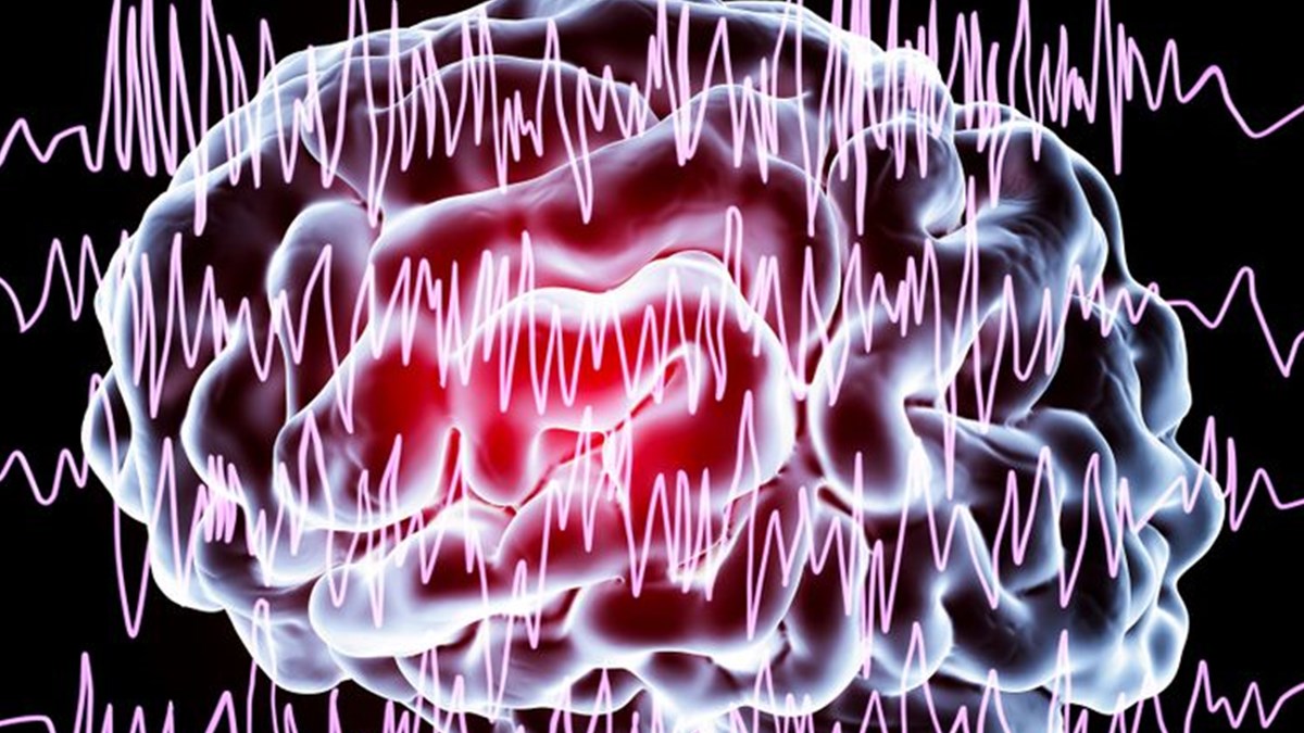 epilepsi ile ilgili dogru sanilan 10 yanlis nobet sirasinda bunlari yapmayin saglik haberleri ntv