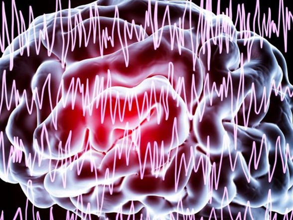epilepsi ile ilgili dogru sanilan 10 yanlis nobet sirasinda bunlari yapmayin saglik haberleri ntv