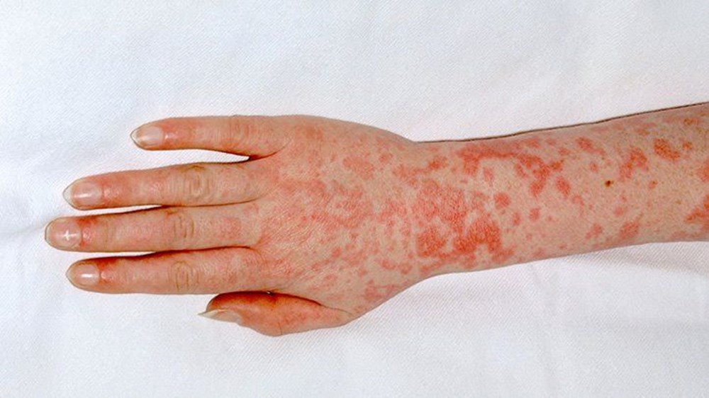 Strep A son bir haftada 6 çocuğu öldürdü: Küresel endişeye neden olan Strep A nedir, Türkiye'de görüldü mü, belirtileri neler? - 9