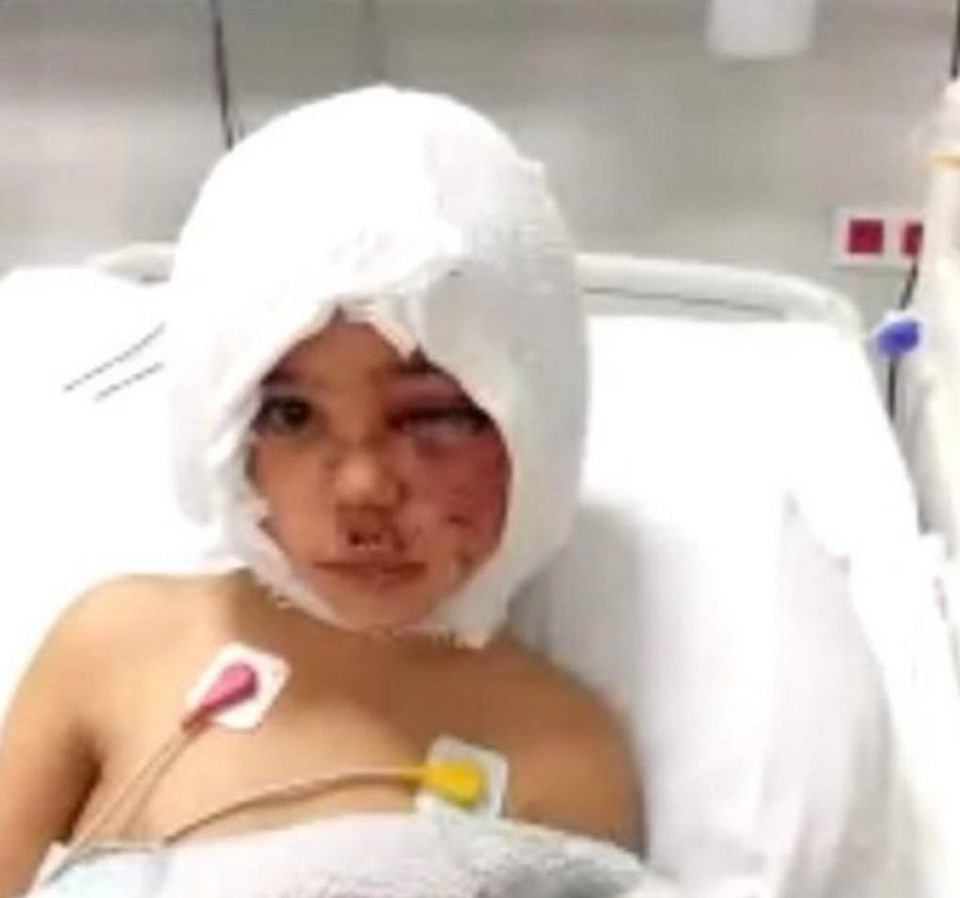 Pitbull saldırısında yaralanan Asiye'nin doku ameliyatı gerçekleştirildi - 1