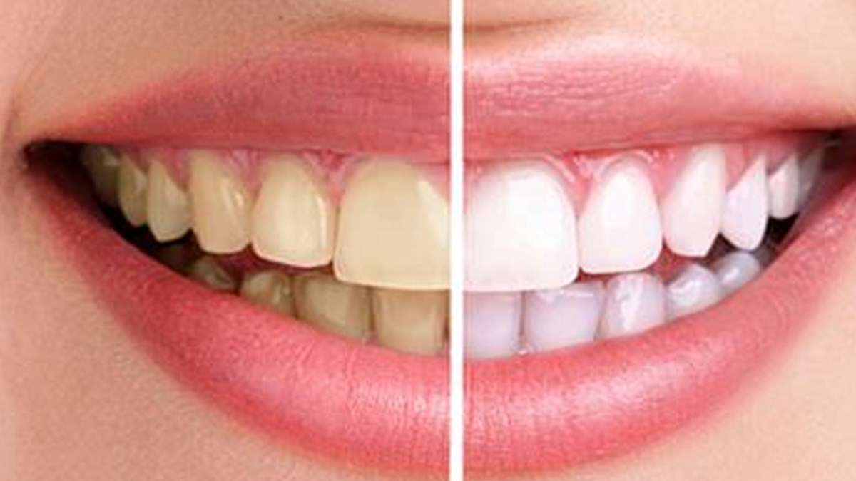 dislerde renk degisimi neyin belirtisi