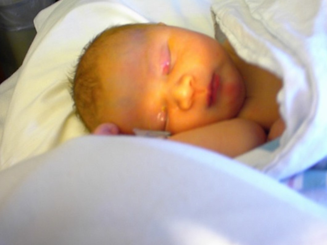 Sarilik Olan Bebeklerde Otizm Riski Yuksek Saglik Haberleri Ntv