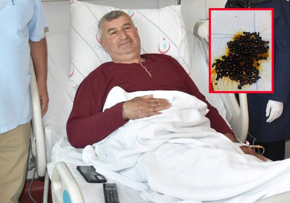 Doktorlar bile şaşırdı: Hepsi safra kesesinden çıkarıldı - 1