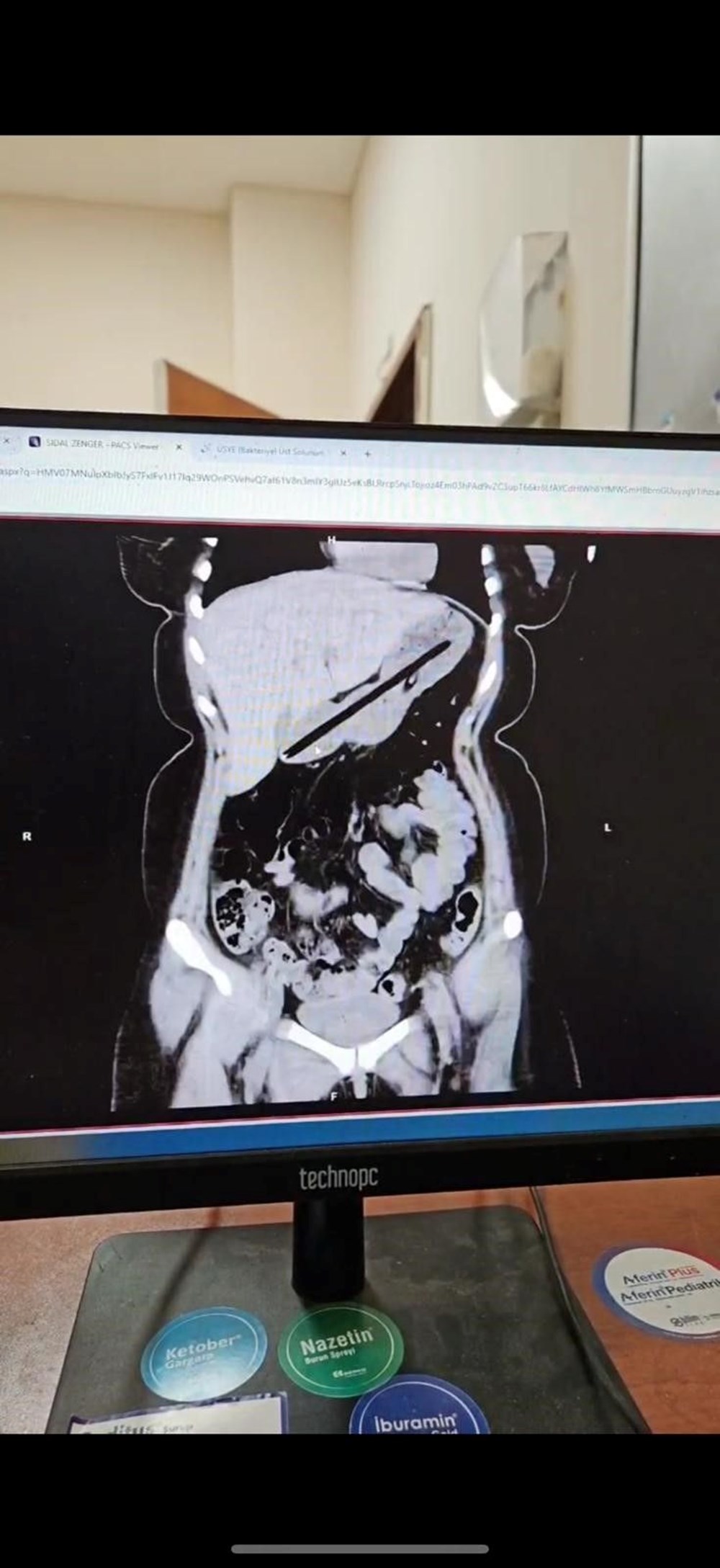 22 yaşındaki kadının midesinden 2 kalem çıkarıldı - 3