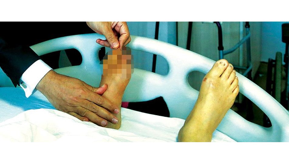 'Diyabetik Ayak' raporu yayımlandı