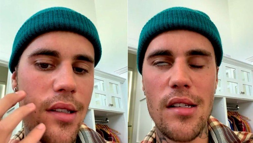 Justin Bieber'ın hastalığı Ramsay Hunt sendromu nedir? - Son Dakika Magazin Haberleri | N-Life