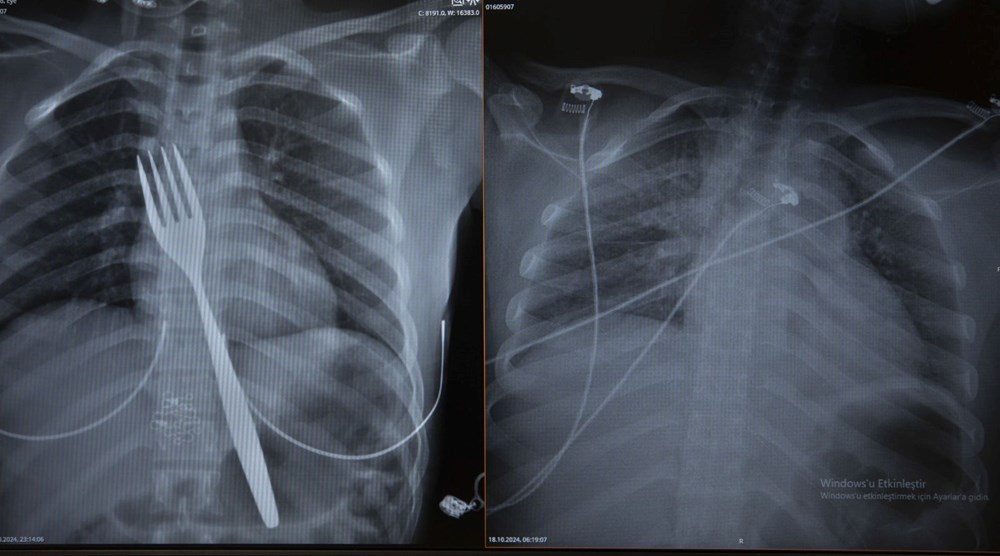 Doktorlar inanamadı, röntgende ortaya çıktı: 18 santimlik çatal ameliyatla çıkarıldı! - 2