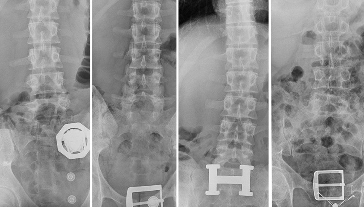 4 şüphelinin midesinden 121 parça eroin çıktı