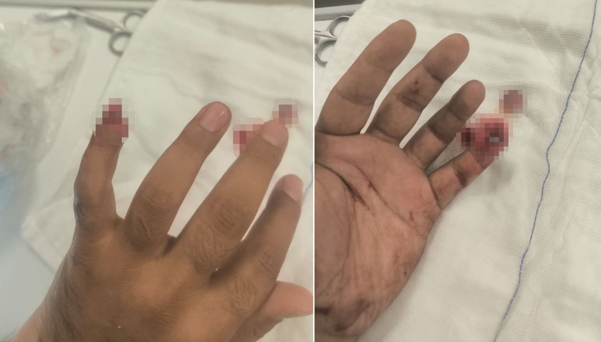 Şüpheli polisin parmağını kopardı Şüpheli polisin parmağını kopardı
