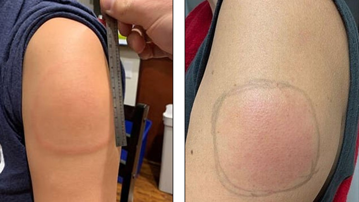 moderna nin asisi covid 19 kolu adi verilen bir yan etkiye yol acti saglik haberleri ntv