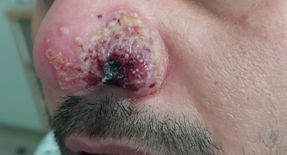 Dünyanın konuştuğu hasta: Önce HIV ve Covid sonra da maymun çiçeği - 10